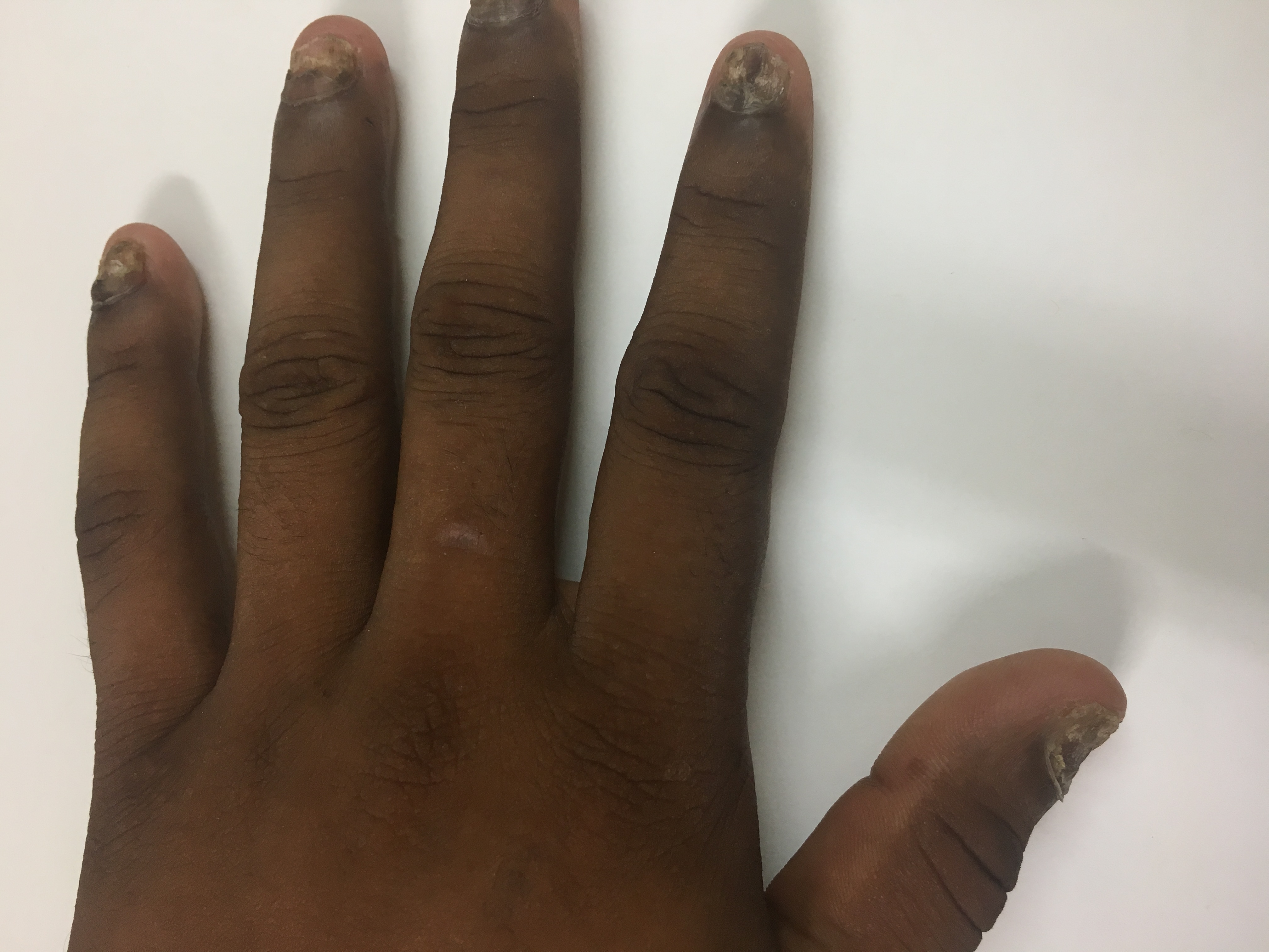 Identify This Condition Of Nails